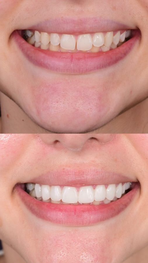 Narrow smile widened and brightened — before and after at Century Smile Maker