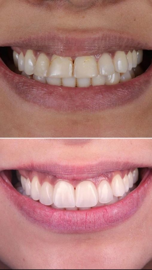 Small, worn teeth restored to full size — before and after at Century Smile Maker