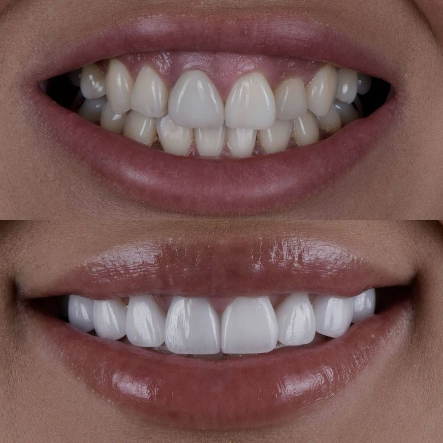 Uneven, stained teeth reshaped and brightened — before and after at Century Smile Maker
