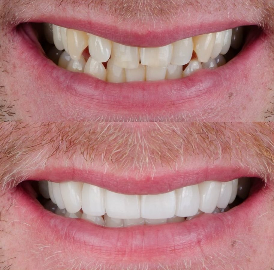 Gaps closed and teeth brightened with veneers — before and after at Century Smile Maker