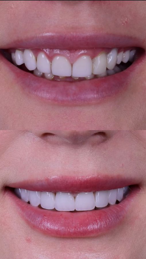 Chips repaired and shade evened out — before and after at Century Smile Maker