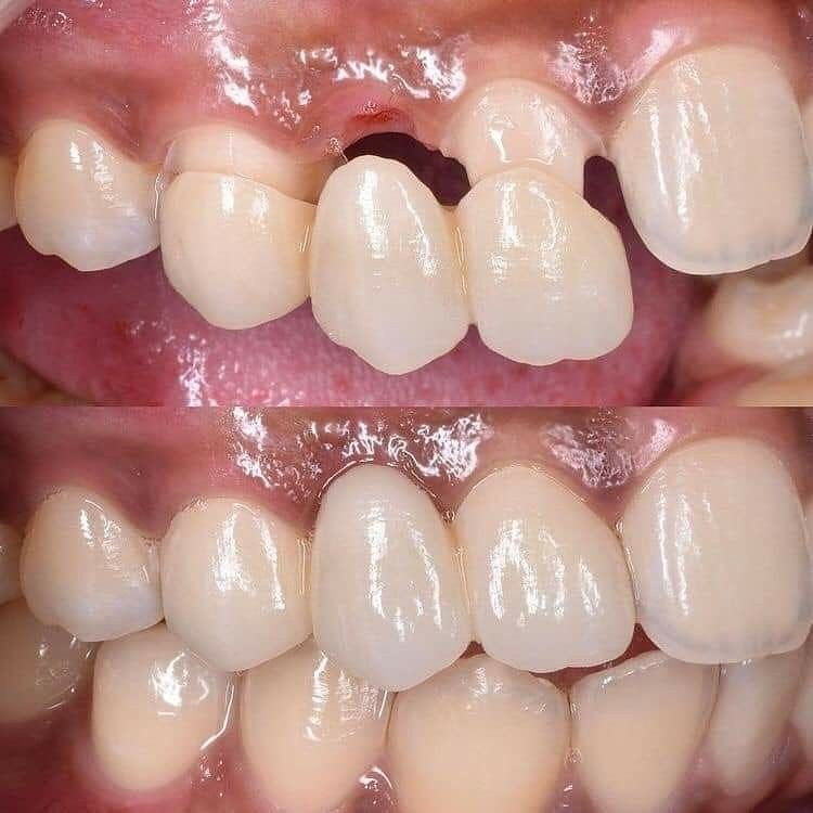 Chipped and worn front teeth restored — before and after at Century Smile Maker