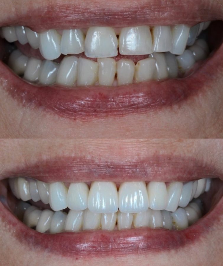 Discoloured teeth restored to a natural shade — before and after at Century Smile Maker