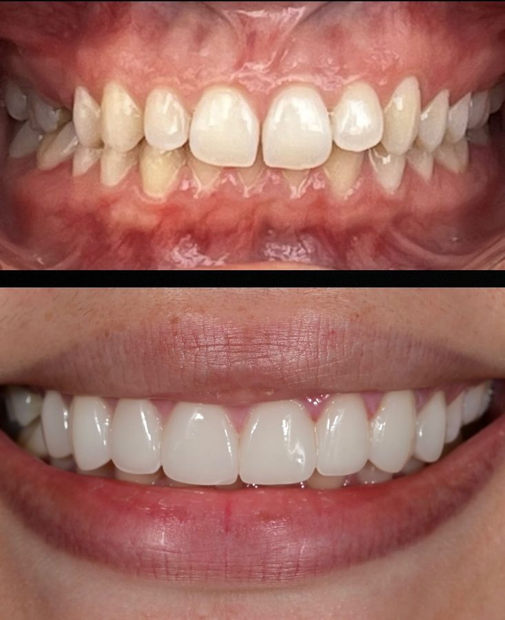 Crowding and staining corrected — before and after at Century Smile Maker