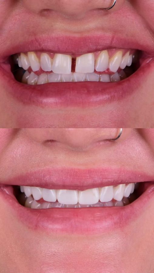 Gapped front teeth closed — before and after at Century Smile Maker