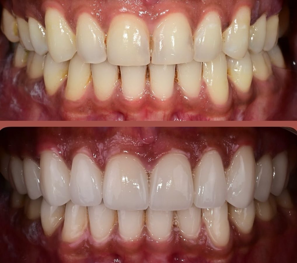Full-arch restoration, worn and discoloured teeth rebuilt — before and after at Century Smile Maker
