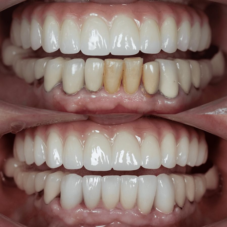 Worn edges rebuilt for an even smile line — before and after at Century Smile Maker