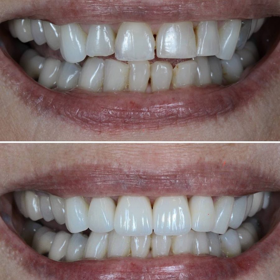 Full smile makeover, upper and lower — before and after at Century Smile Maker