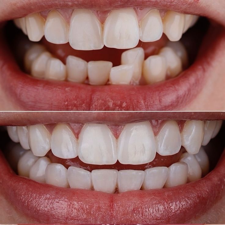 Spacing corrected and shape evened out — before and after at Century Smile Maker