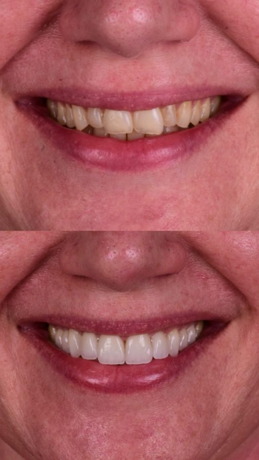 Discolouration and wear corrected — before and after at Century Smile Maker