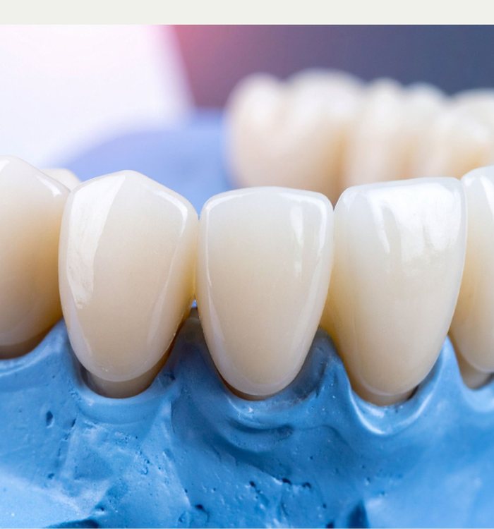 Porcelain Veneers — Century City dental care