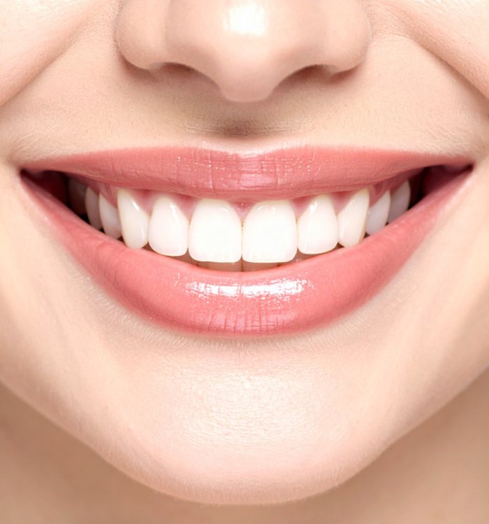 Bright smile after in-office Zoom teeth whitening